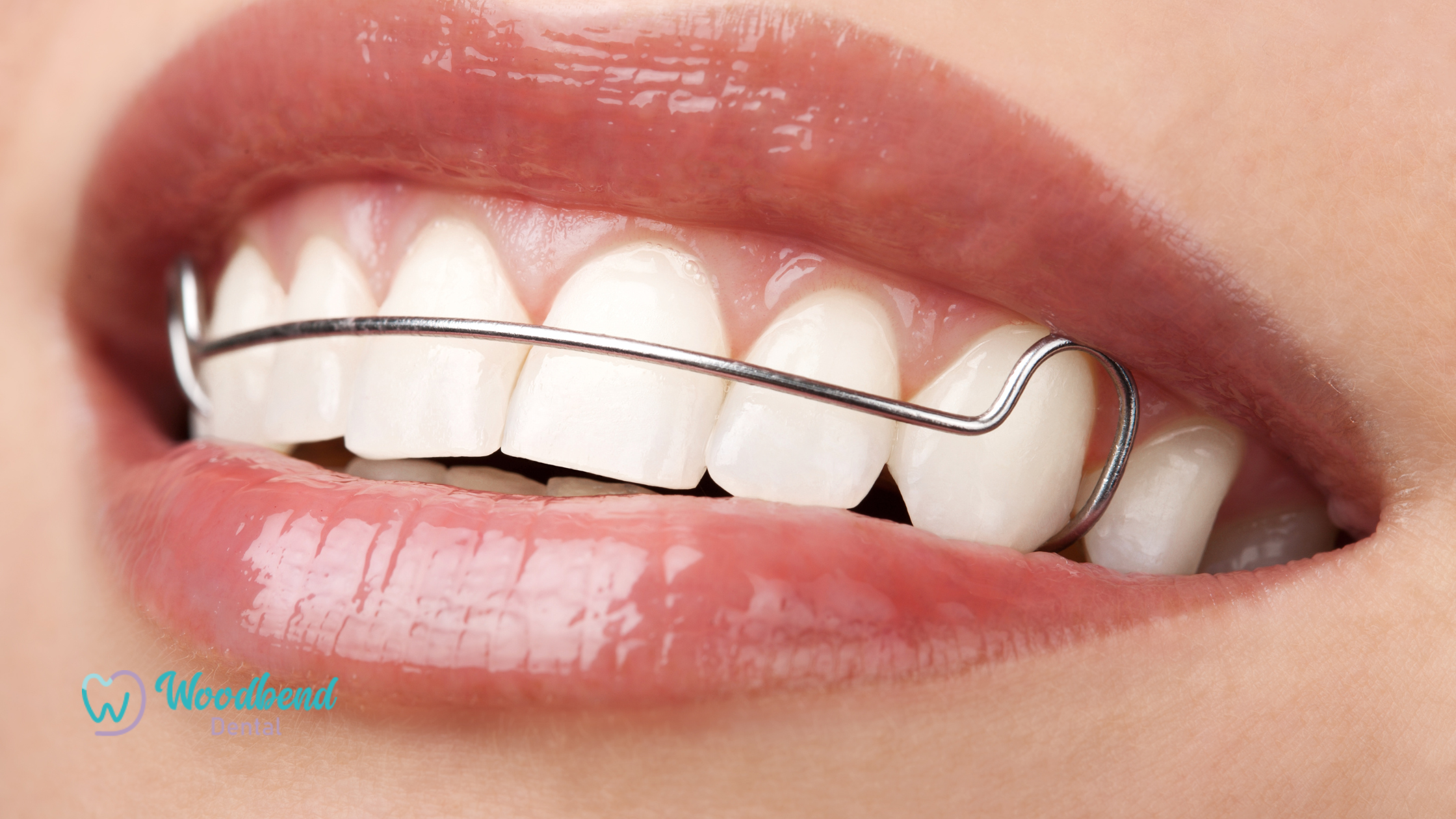 How to Clean and Maintain Your Retainer