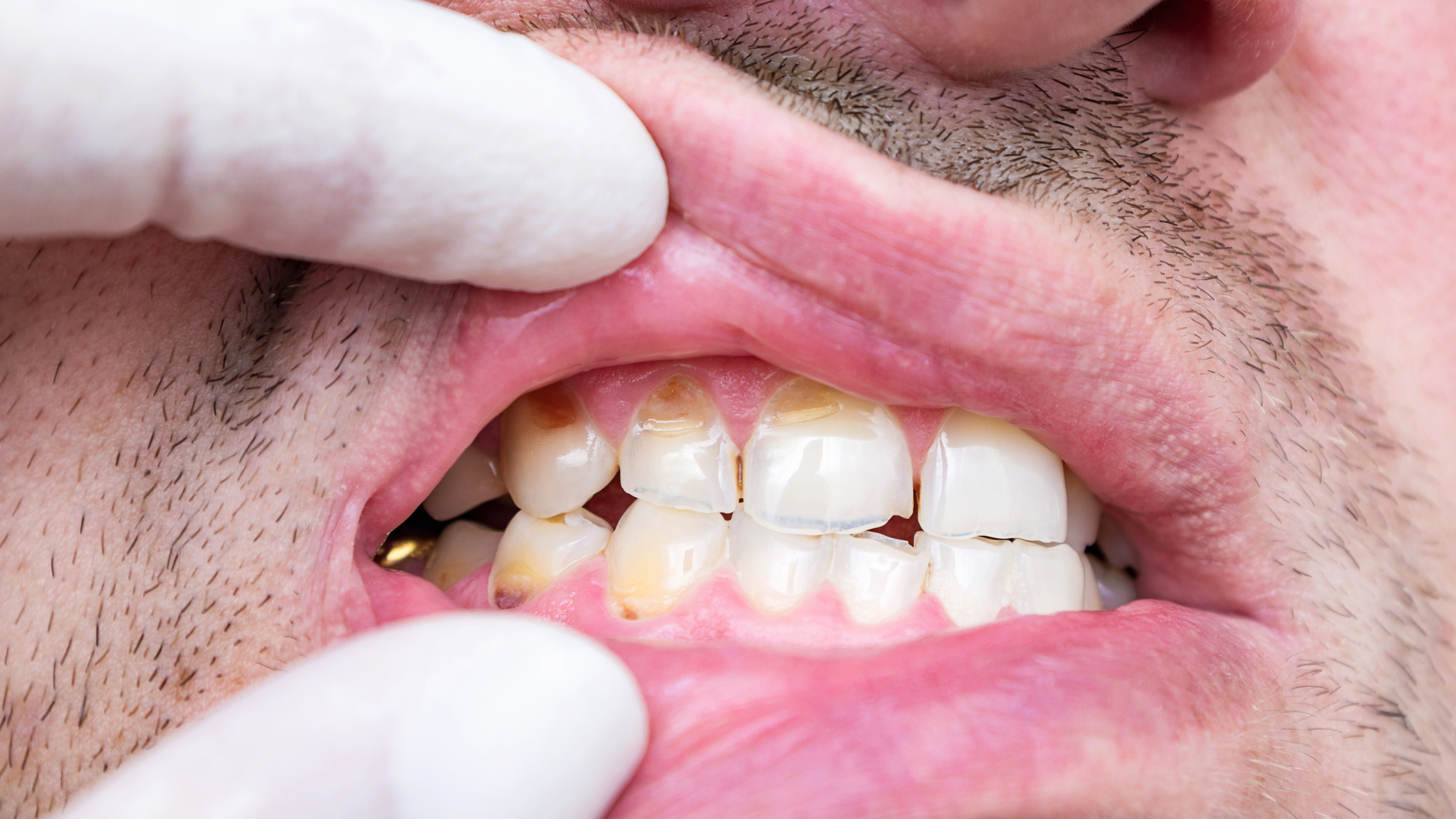 The Effects of Caffeine on Oral Health