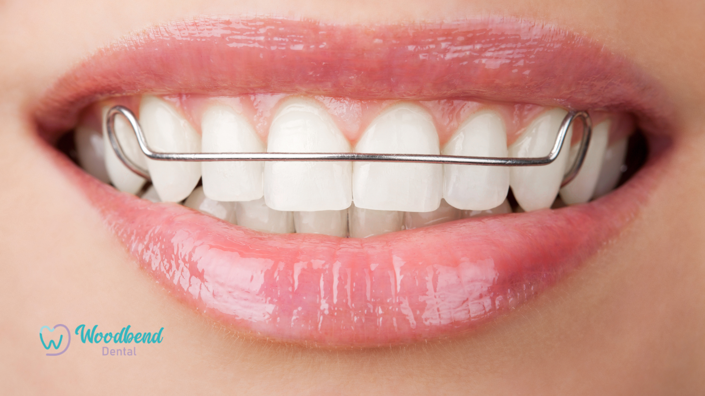 The Role of Retainers in Maintaining a Straight Smile