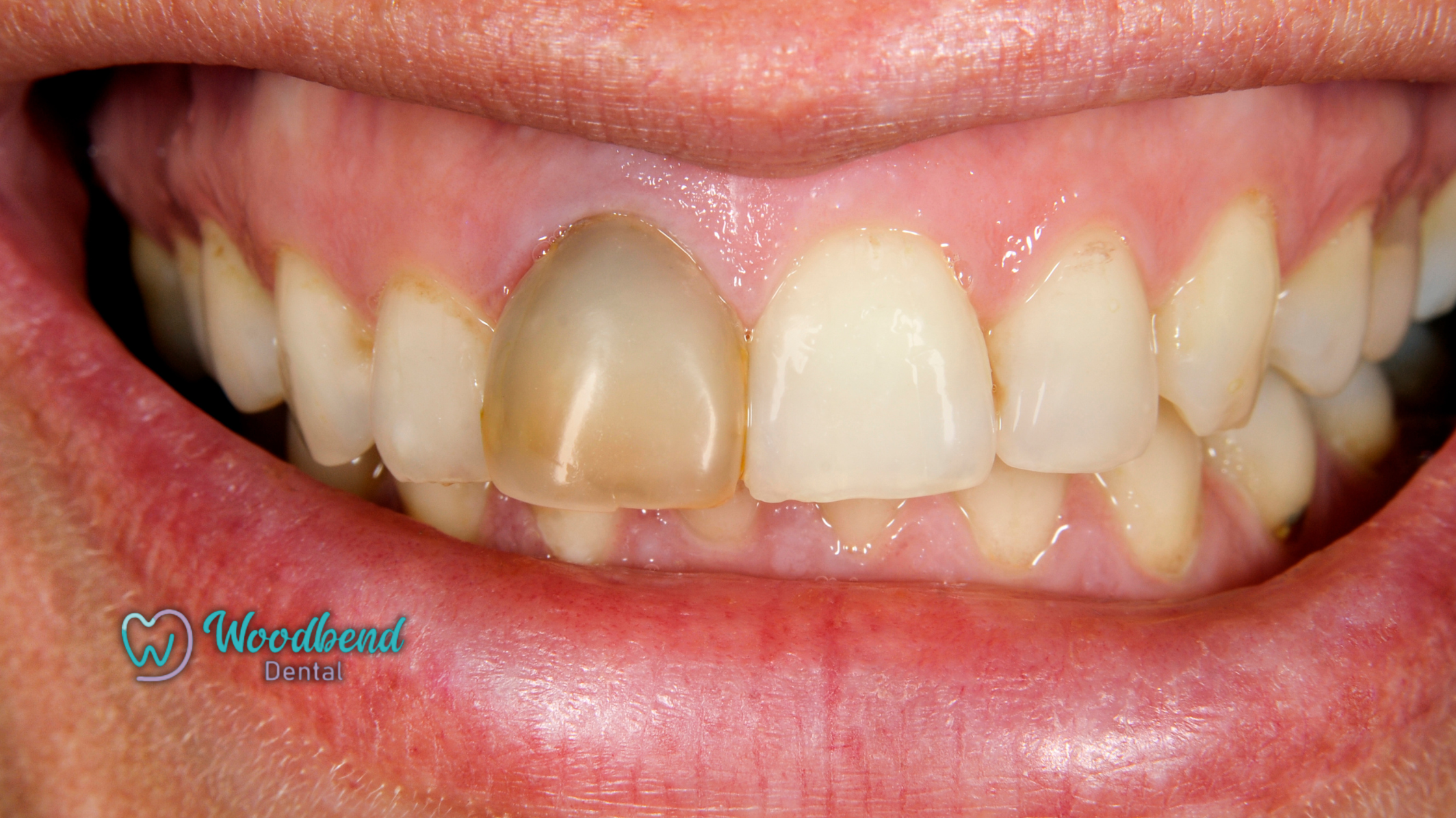 How to Tell If a Tooth Is Dead