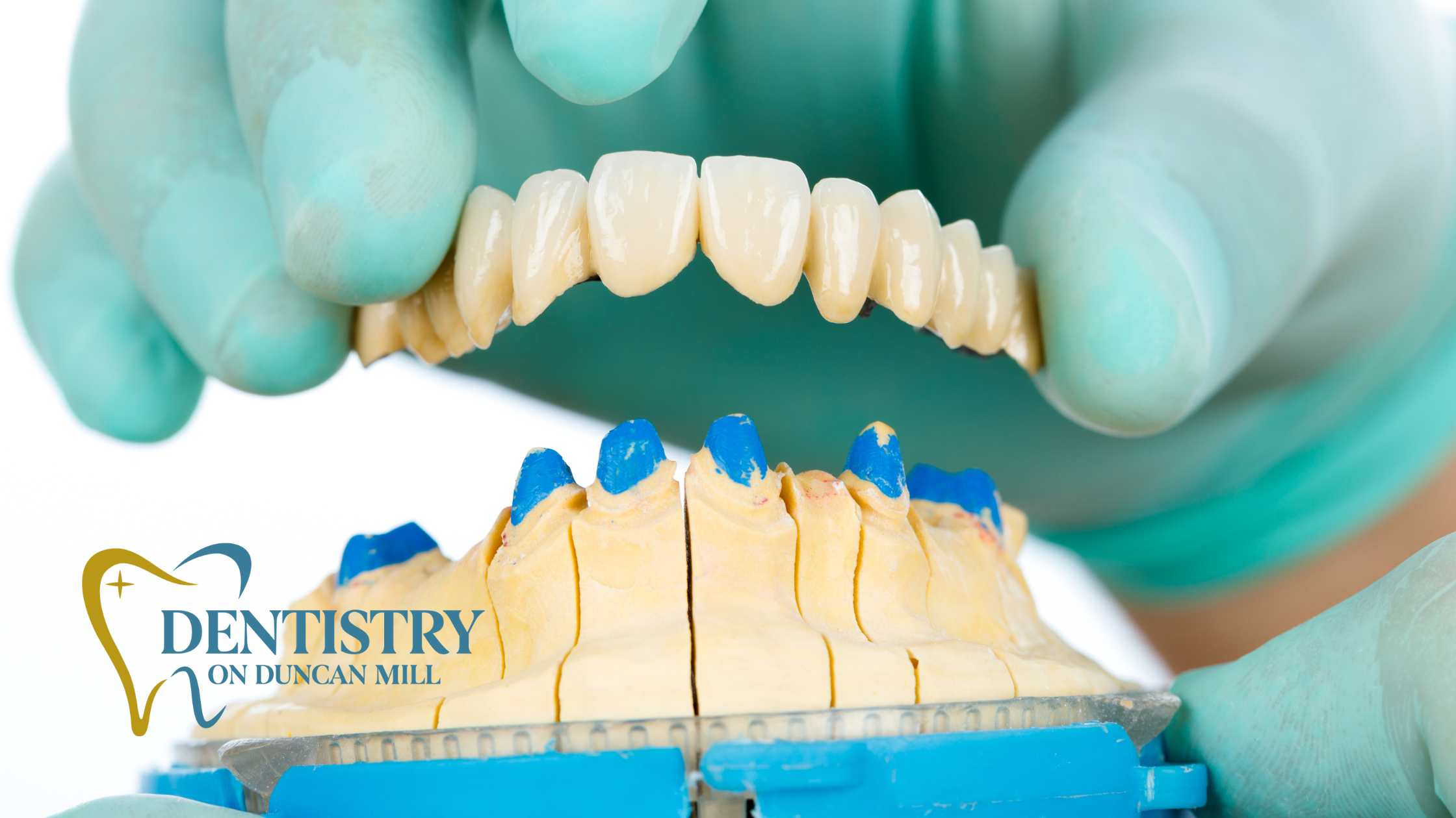 Learn about the lifespan of dental bridges and how to care for them. Discover tips to extend durability and keep your smile healthy.