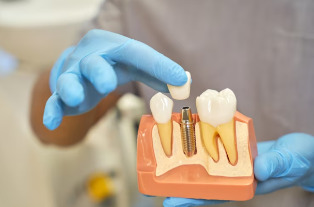 Dental Implants Toronto