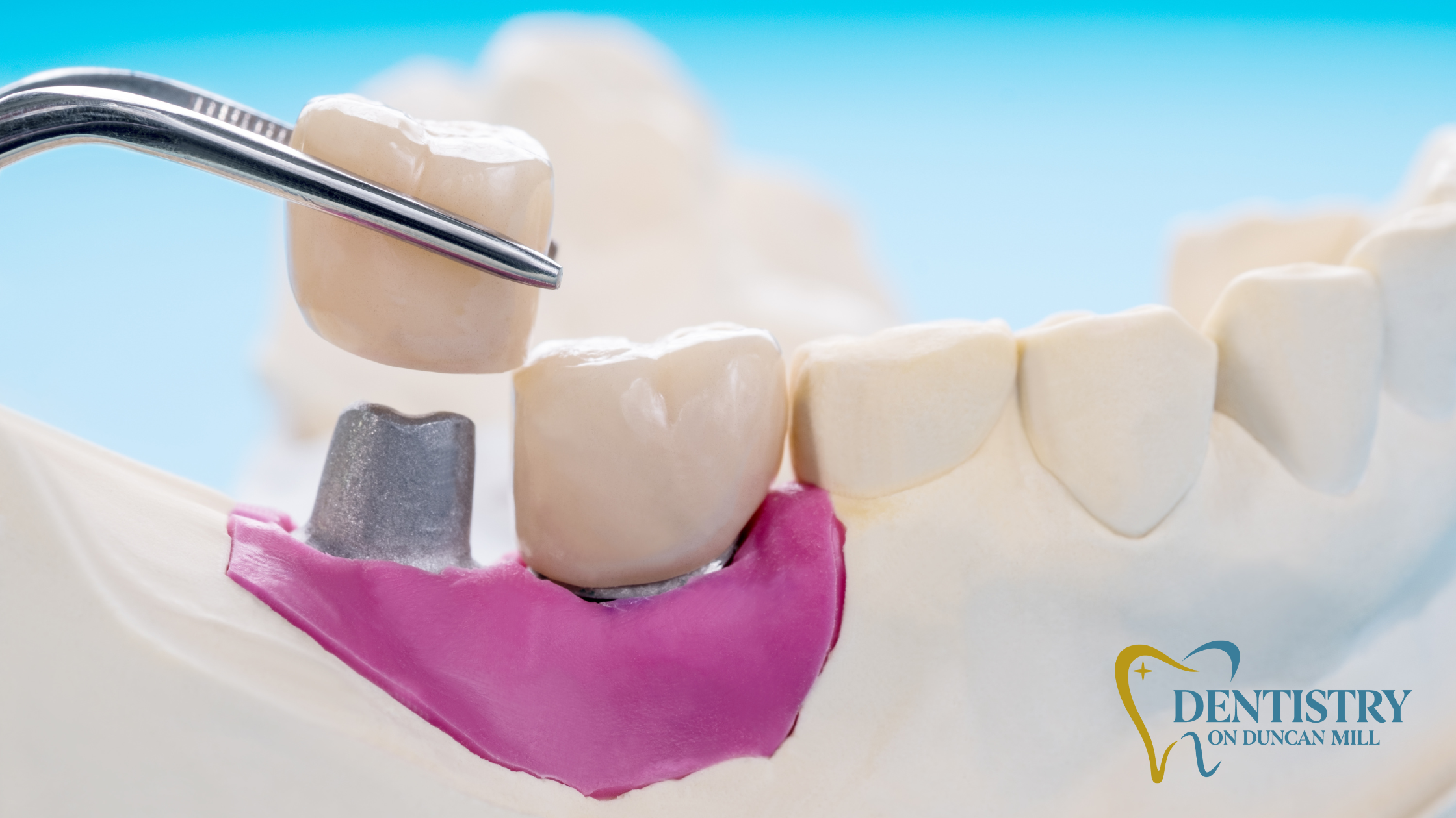 How to Choose Between a Bridge and an Implant After Tooth Loss
