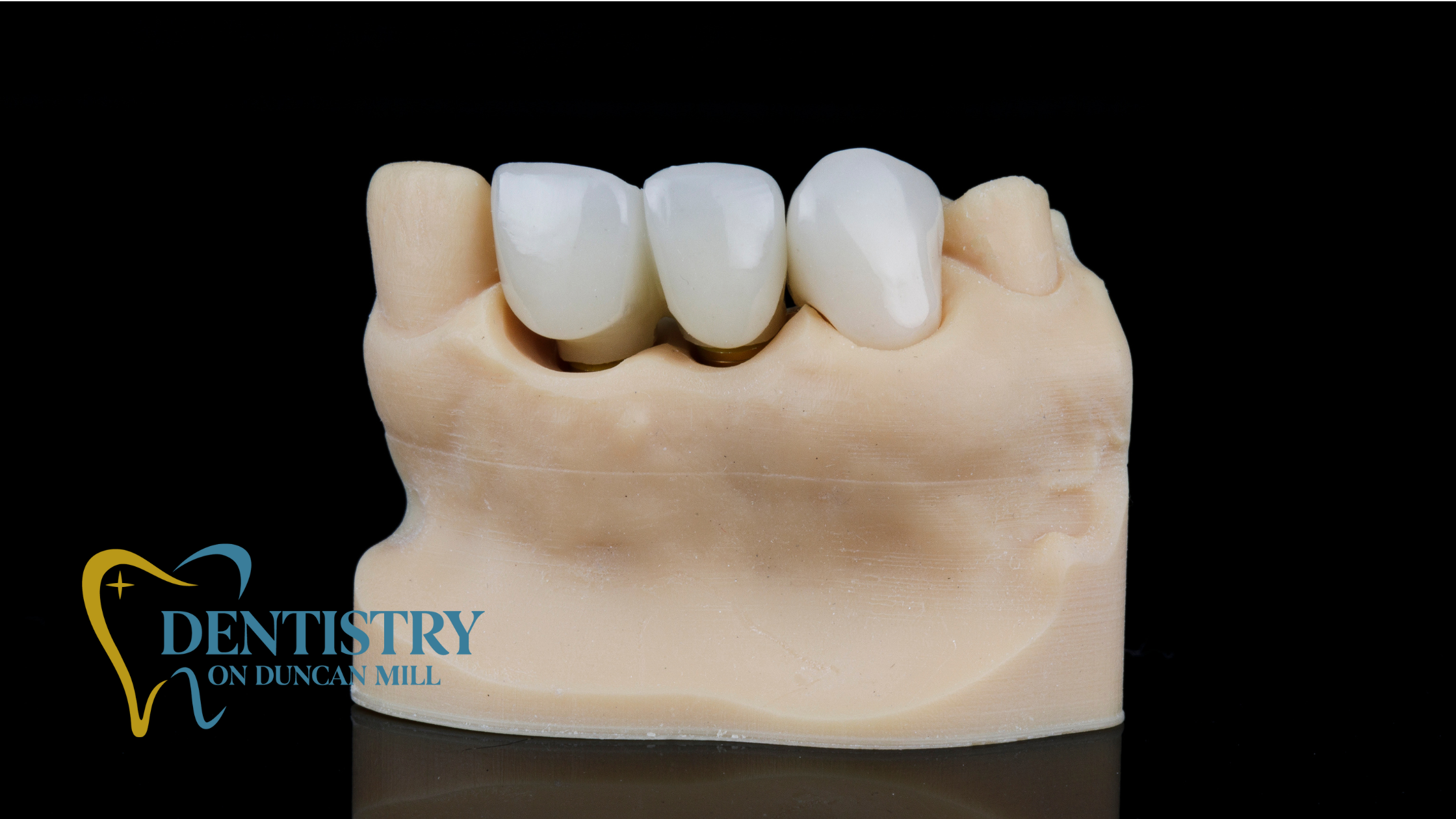 What to Expect During Dental Bridge Placement