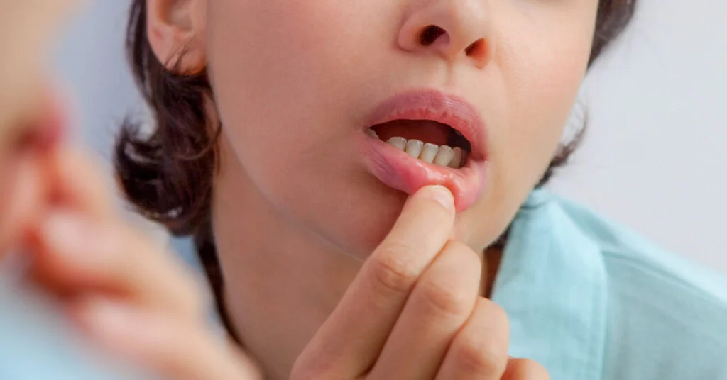The Possible Causes of Canker Sores