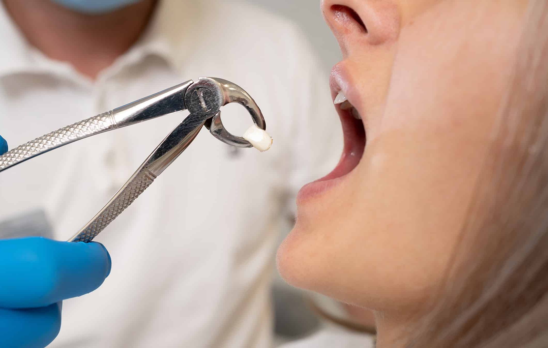 Emergency Tooth Extraction in Calgary