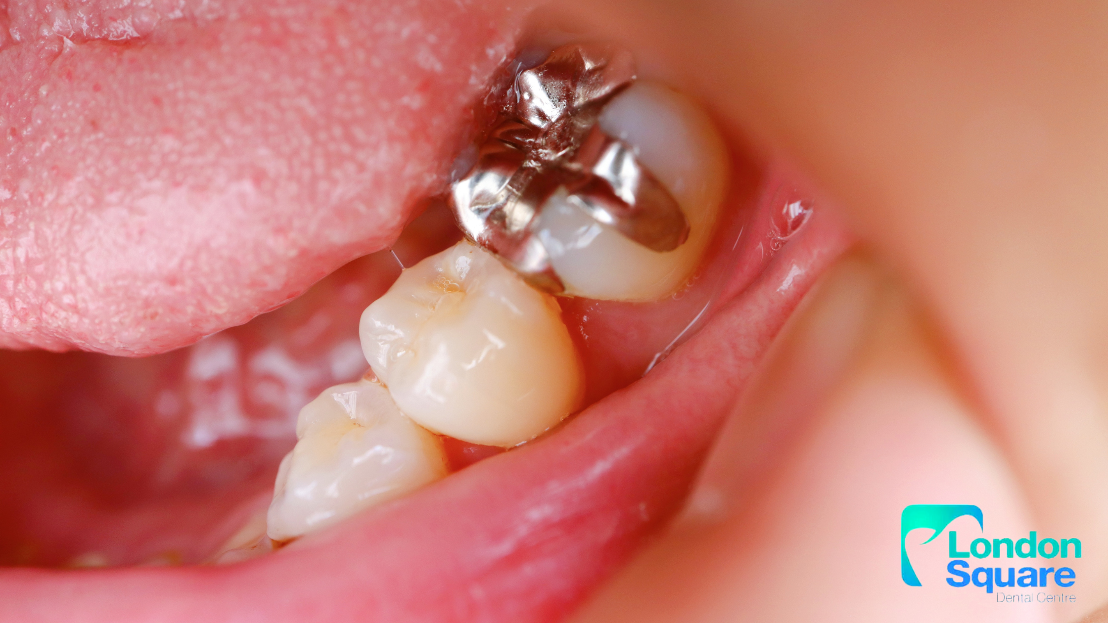 How Replacing Silver Fillings Impacts Your Health and Smile