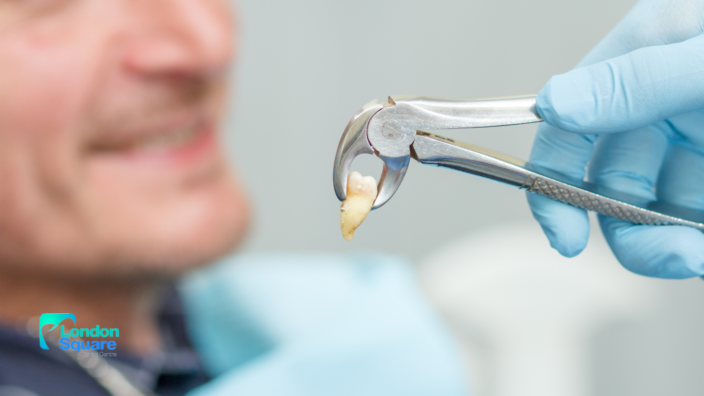 What Happens to Bone After Tooth Extraction