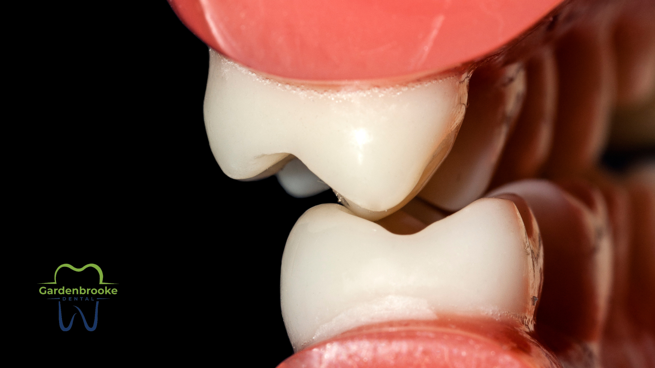 The Importance of Occlusal Adjustments in Fillings