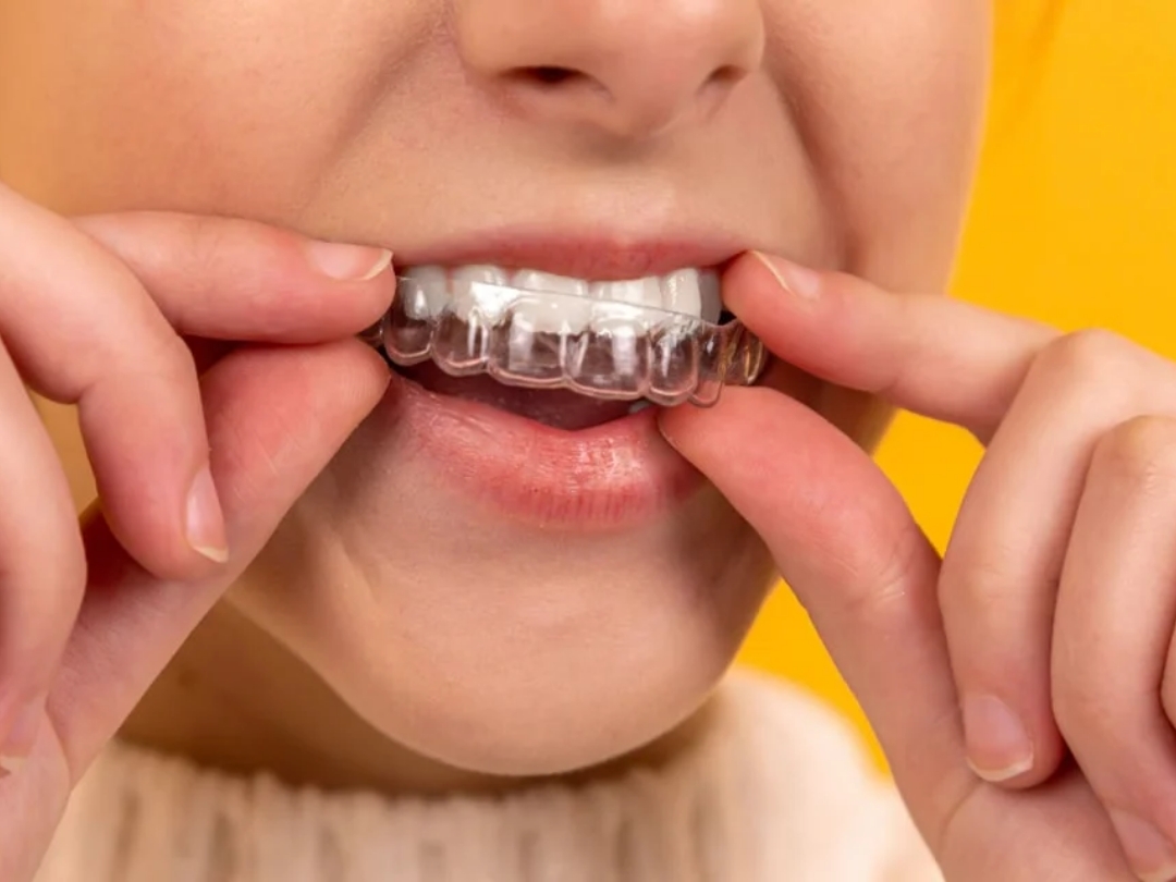 Edmonton Dentist: Differences Between Gingivitis and Periodontitis