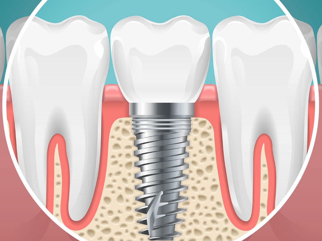 Discover the Benefits of Dental Implants at Allard Station Dental