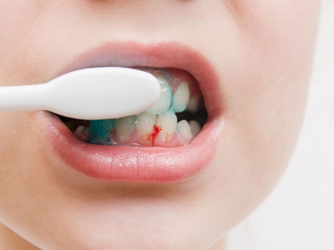 Are Bleeding Gums Something To Worry About?