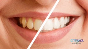 How to Tell the Difference Between Tartar and Stains