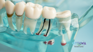 Can Preventive Dentistry Help Avoid Root Canals?